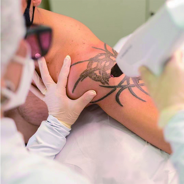 tattoo treatment