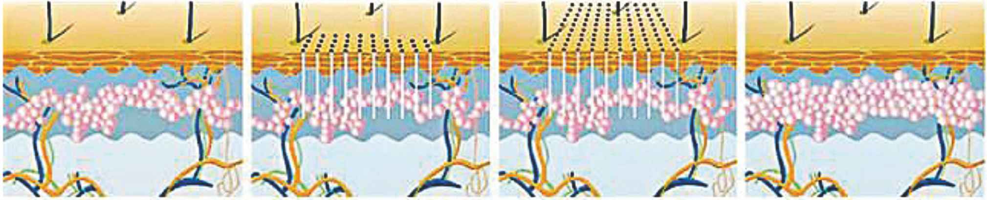 1550nm Erbium Fiber Laser----Deep remodeling 1550nm Erbium Fiber Laser----Deep remodeling