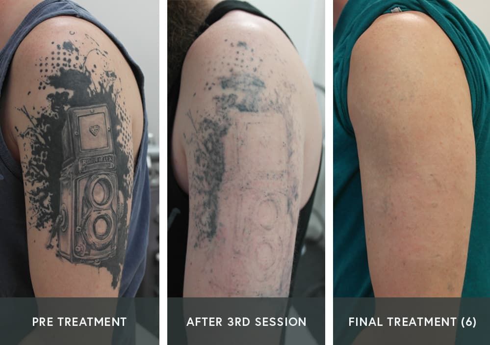 tattoo removal-2