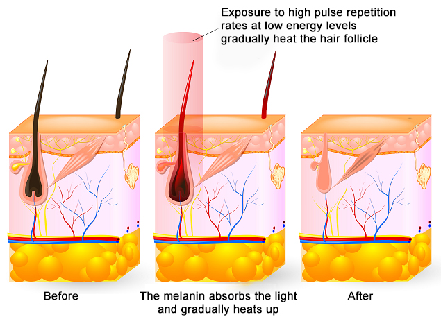 ipl SHR principle