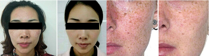 HS-298 before after photo (2)
