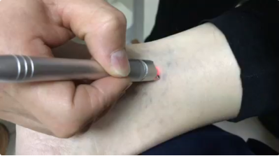 30W Portable Vascular Removal 980nm Diode Laser