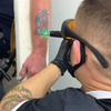 Vertical Q-Switched Nd Yag Laser Tattoo Removal Machine
