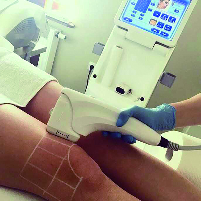 Multi-lines HIFU HS-511