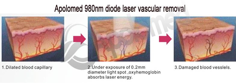 980nm diode laser vascular