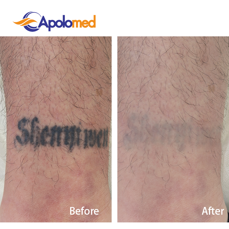 祛纹身治疗对比图2