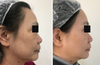300~500ps Vertical Fast Skin Resurfacing Picosecond Nd Yag Laser Device