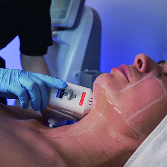 Multi-lines HIFU HS-511