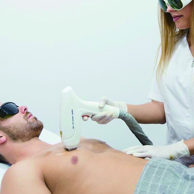 hair removal laser