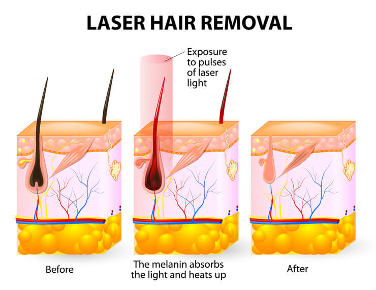triple diode laser principle